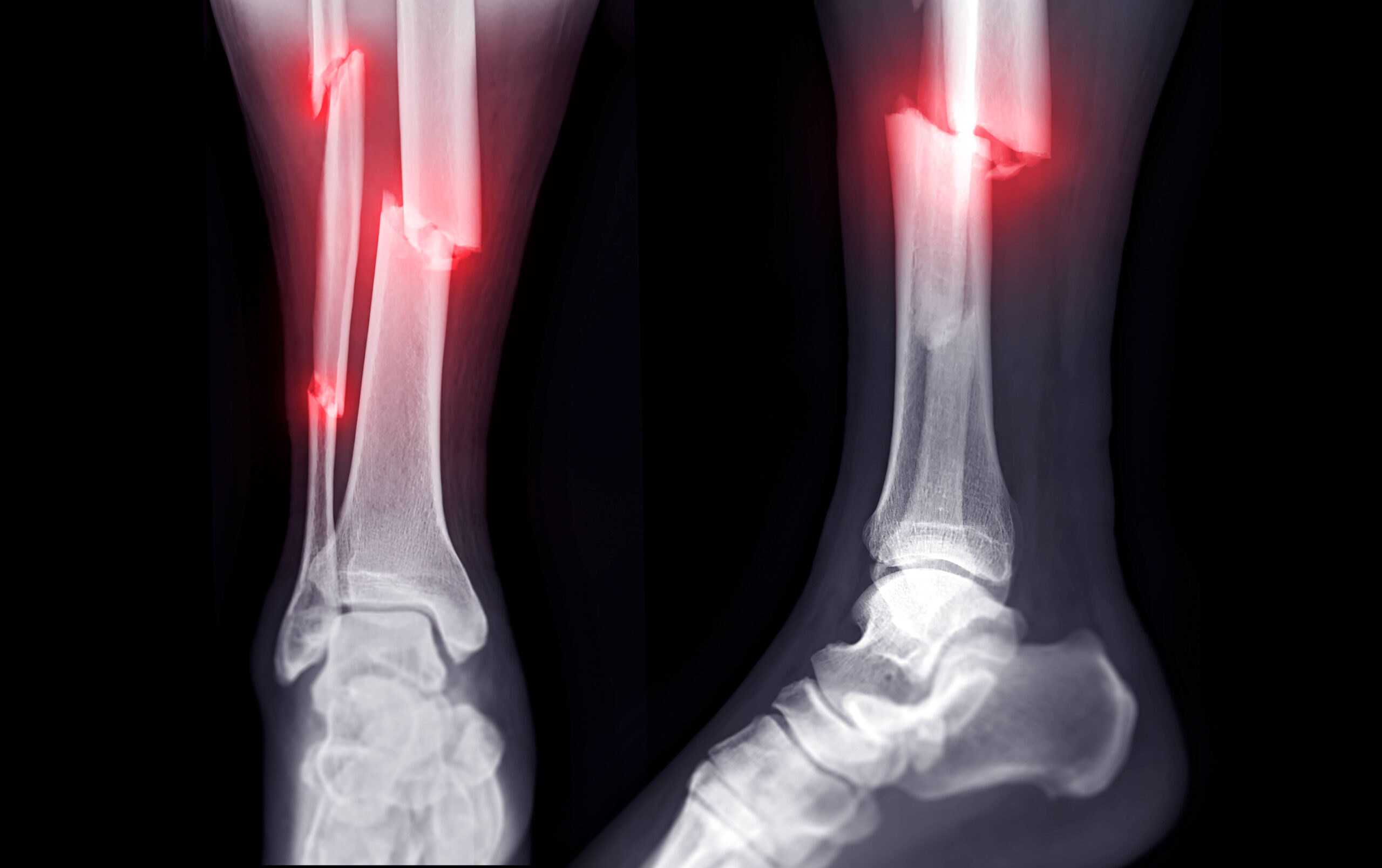 Bone Fracture Treatment in Mohali | Livasa Hospitals